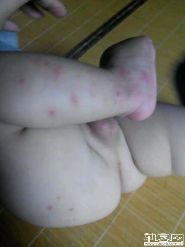 什么病需要打点滴治疗 163410eialigbppaepooji.jpg